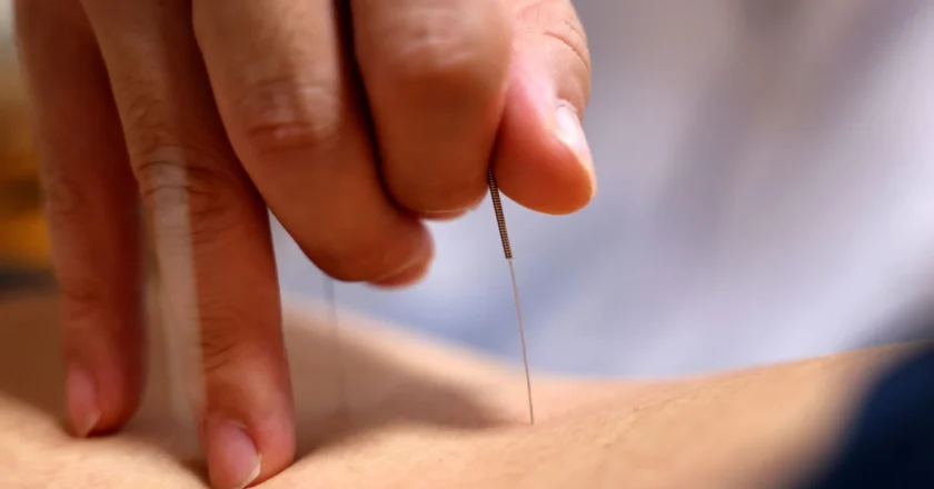 Acupuntura: principais benefícios no tratamento de dor e reabilitação